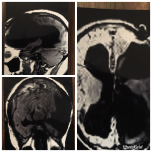 Images of Kali's brain after her accident